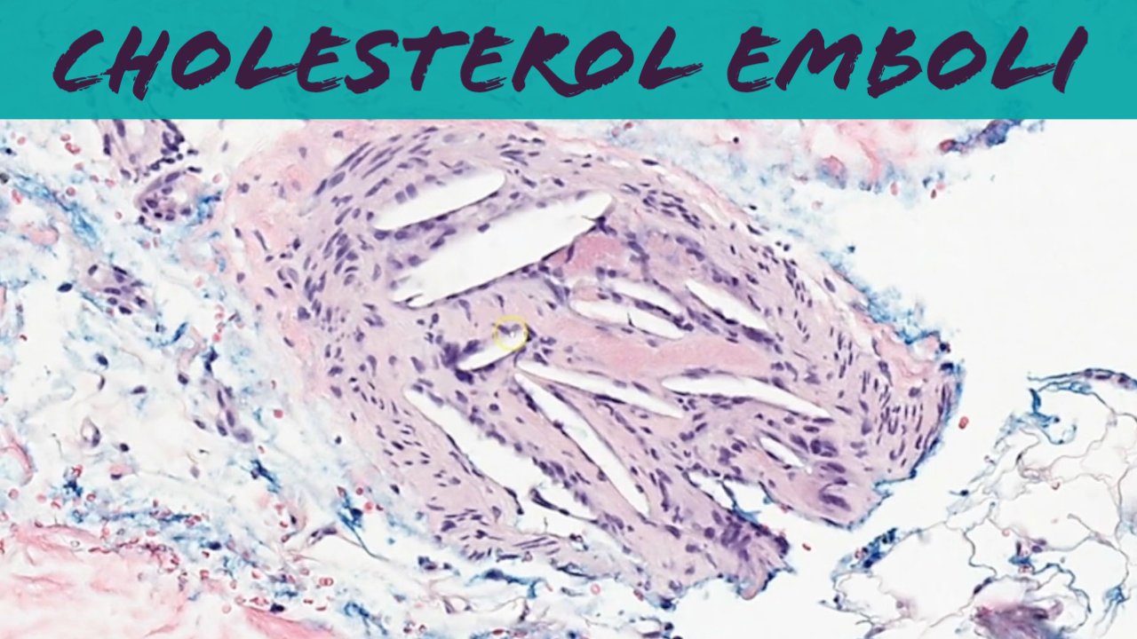 Cholesterol emboli artery blocked by detached fragment of
